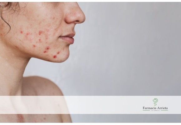 ¿Cómo debe ser tu rutina facial para combatir el acné?