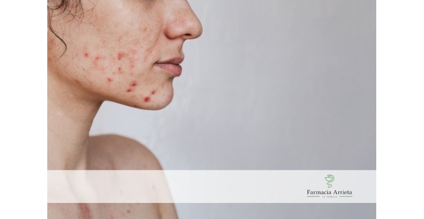 ¿Cómo debe ser tu rutina facial para combatir el acné?